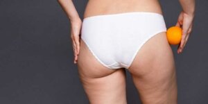 Cellulit - jakie zabiegi i urządzenia. Fot. mat. prasowy