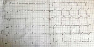 EKG