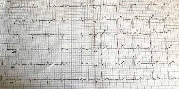 EKG - wykres badania. Fot. Maciej Janiszewski